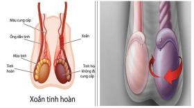 Cơn đau bìu tưởng bình thường nhưng là cấp cứu tối khẩn cấp